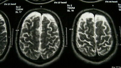 MRT-Scan eines Gehirns im Querschnitt, auf dem linke und rechte Gehirnhälfte zu sehen sind