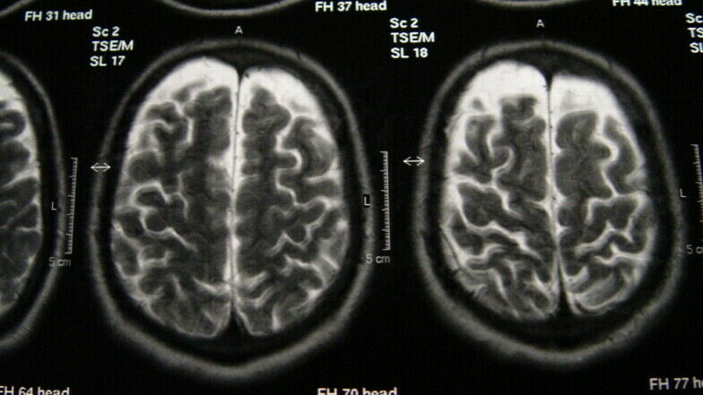 MRT-Scan eines Gehirns im Querschnitt, auf dem linke und rechte Gehirnhälfte zu sehen sind