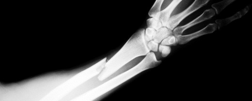 Röntgenbild eines Oberarms mit gebrochener Speiche