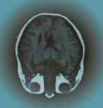 Querschnitt eines Gehirns in der Magnet-Resonanz-Tomographie